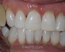 Teeth Whitening