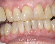 Teeth Whitening