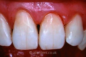 After Composite Bonding