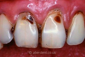 Before Composite Bonding