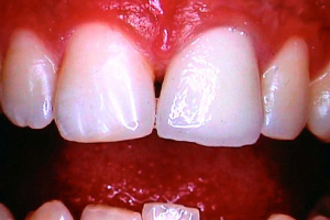 After Crowns