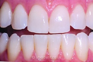 After Whitening