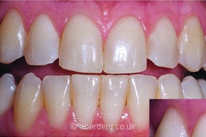 Before Whitening